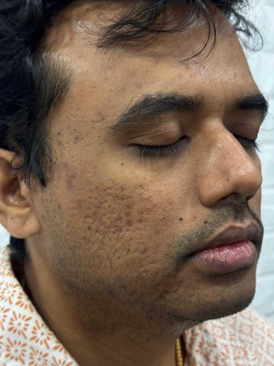 Acne Scar Treatment after