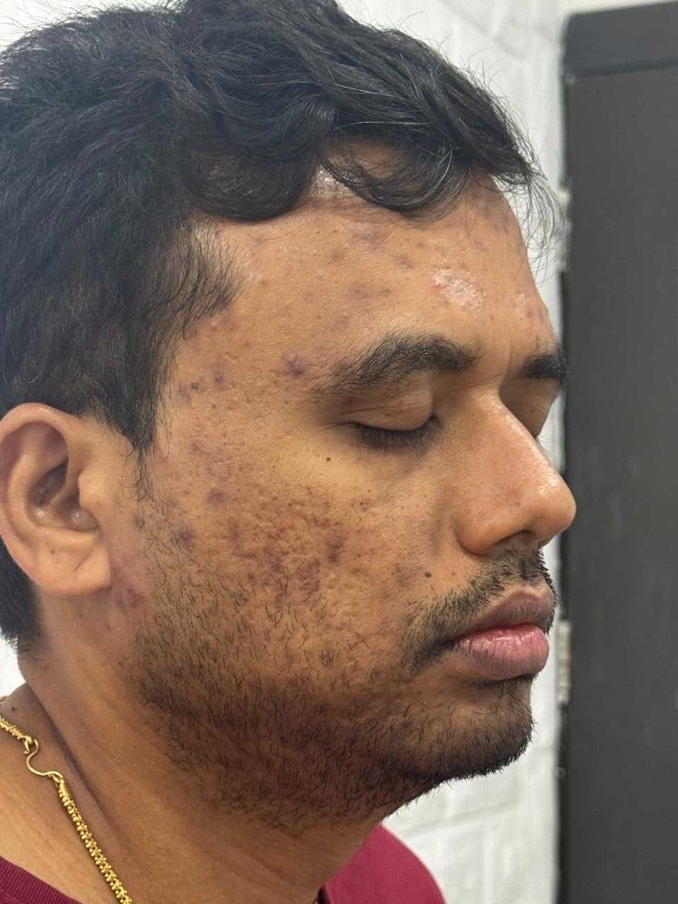 Acne Scar Treatment before