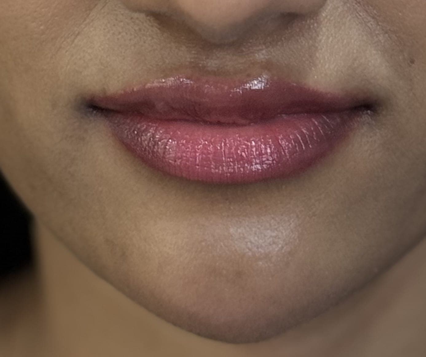 Injectables after