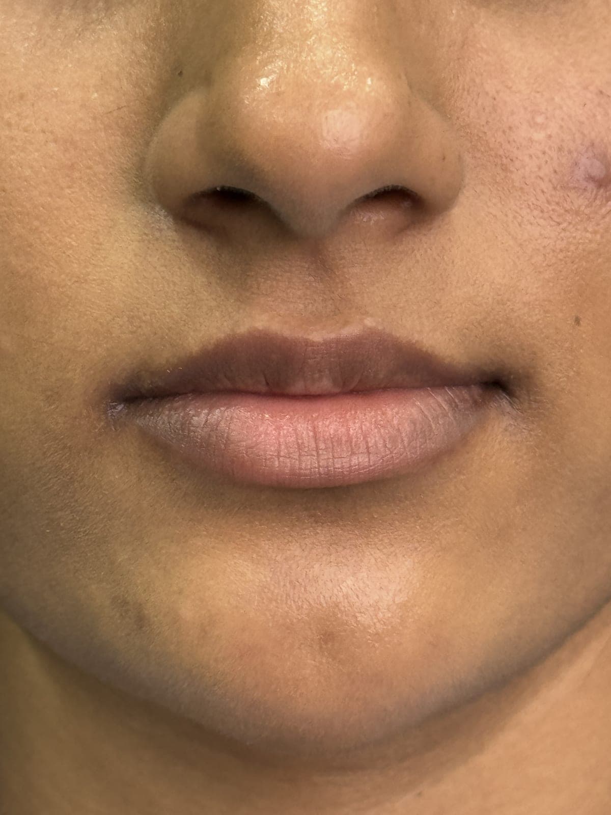 Injectables before