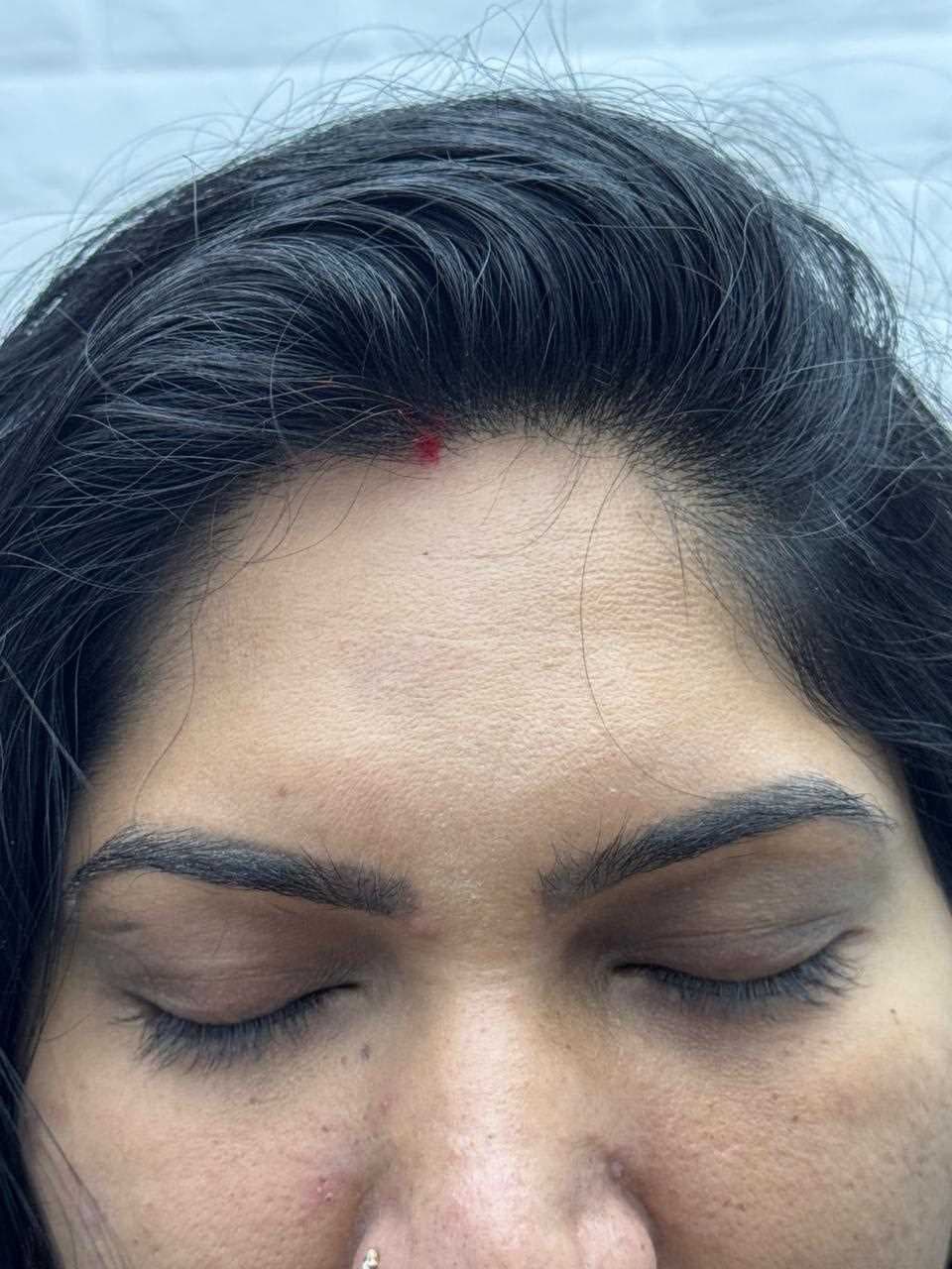Pigmentation Treatment after