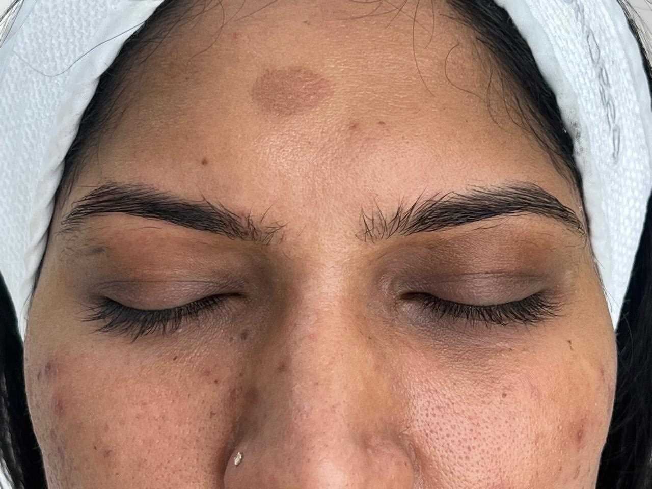 Pigmentation Treatment before