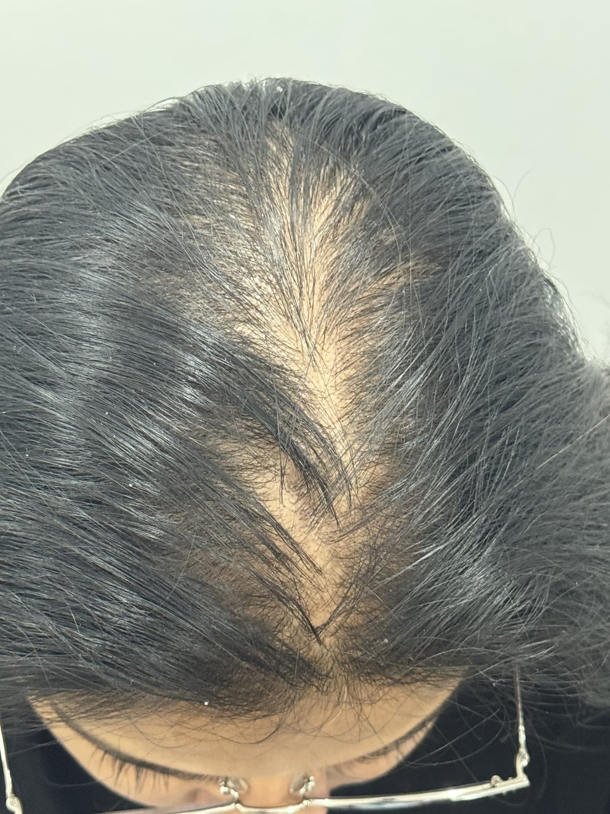 PRP Hair Treatment before