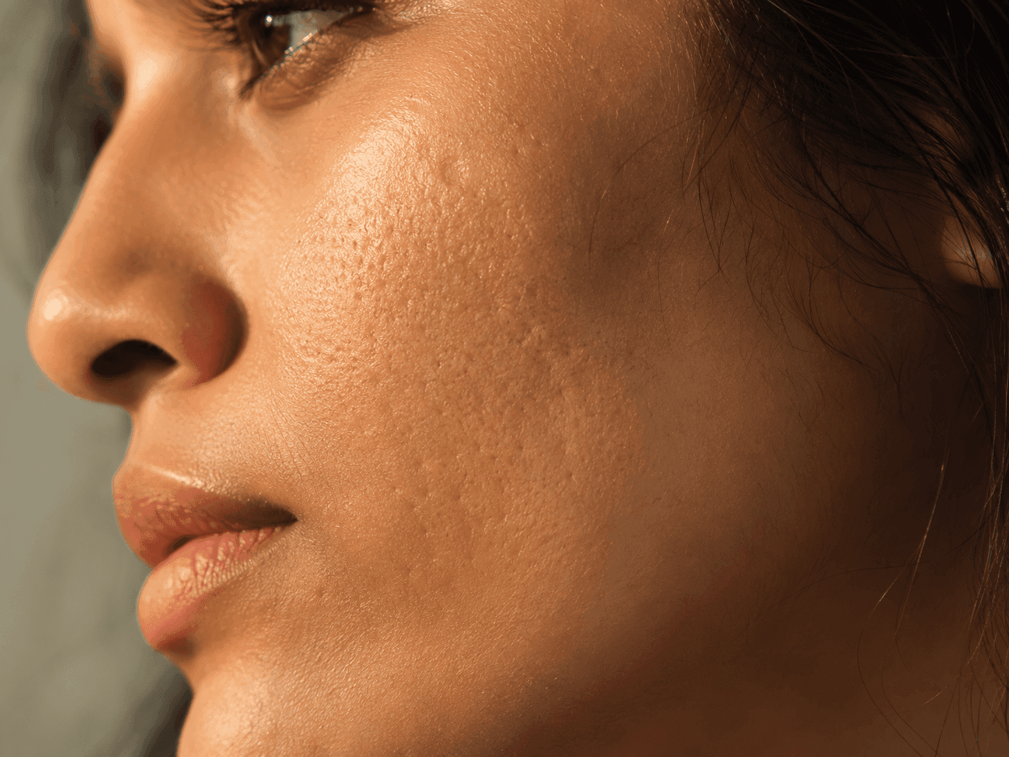 Acne Scar Treatment