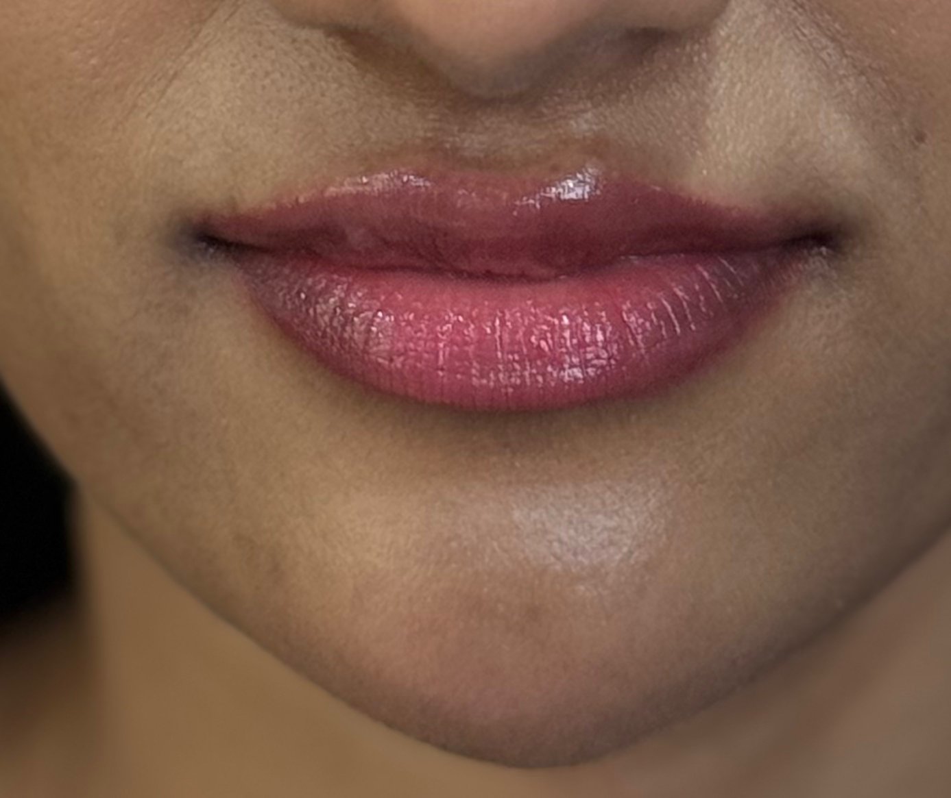 Injectables after