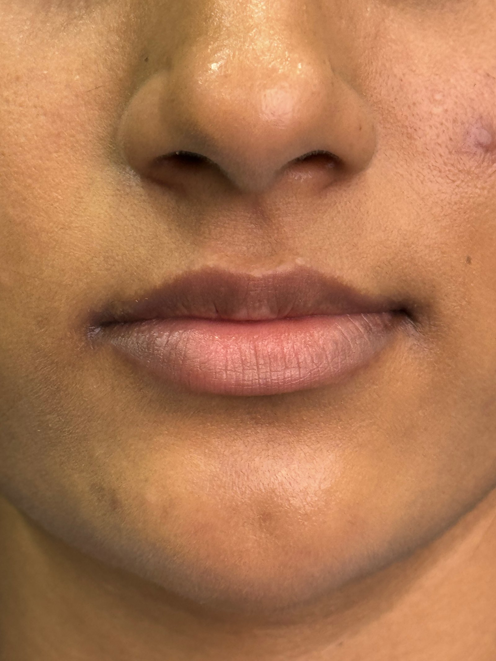 Injectables before