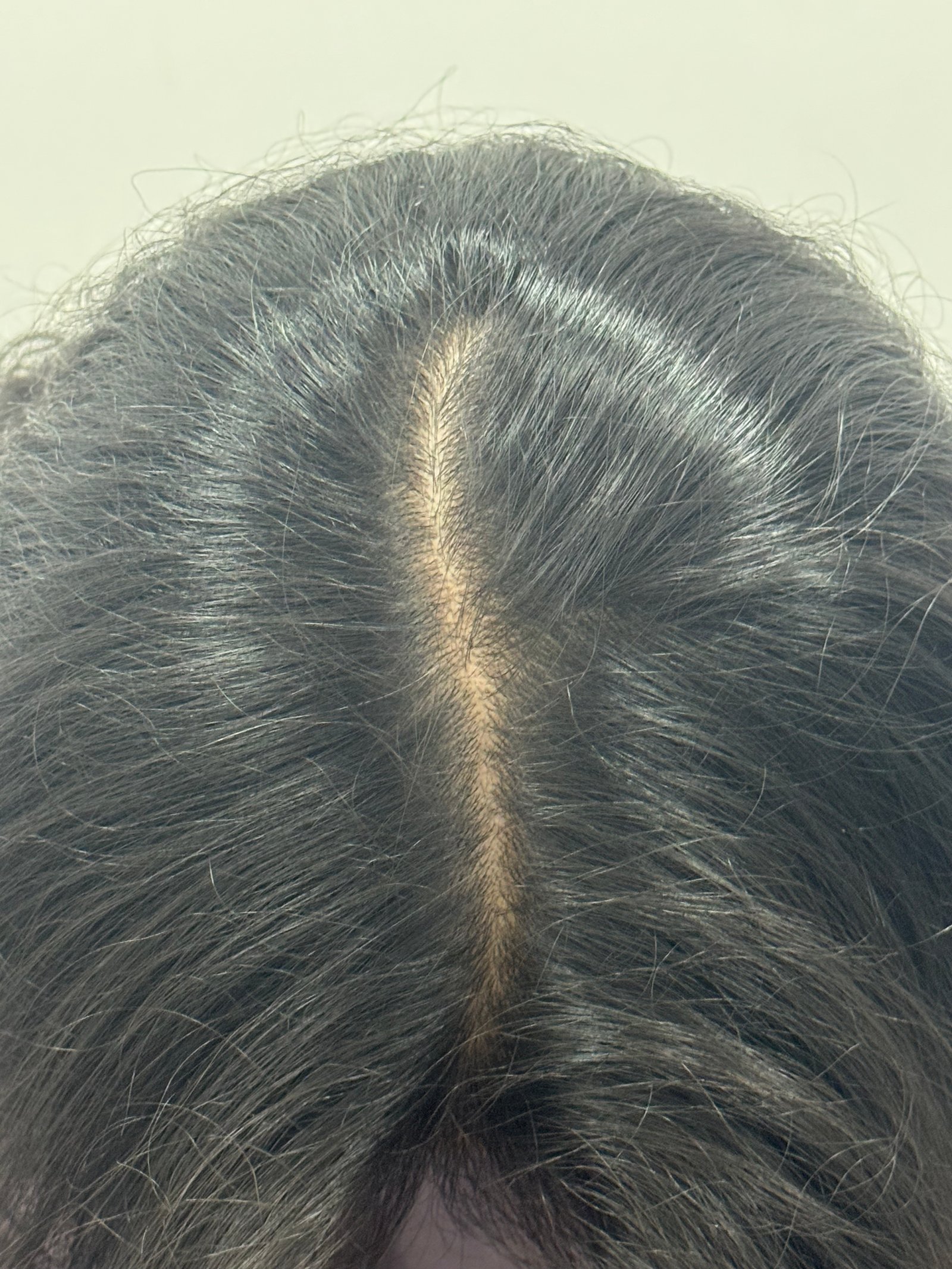 PRP Hair Treatment after